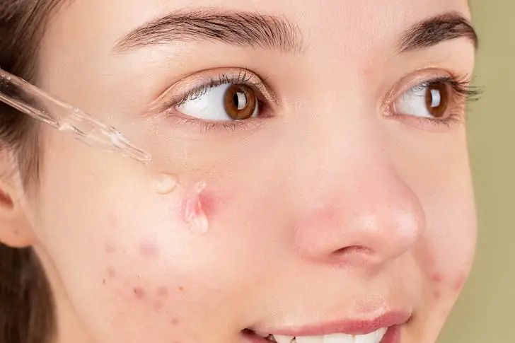How to treat every kind of acne at home.