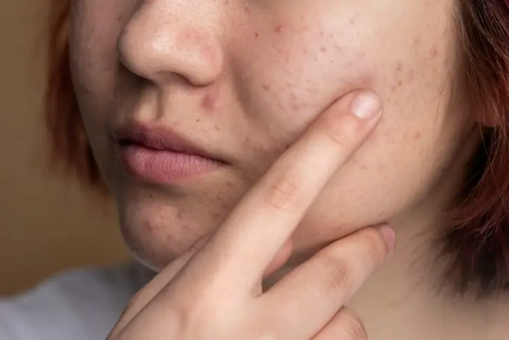 How to treat every kind of acne at home.